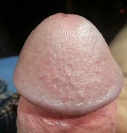 Photo of the enlarged glans penis