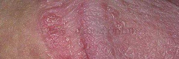 Dry skin and ulcers on the head of the penis after using baking powder