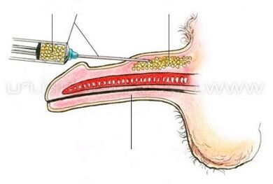 Penis enlargement by injection