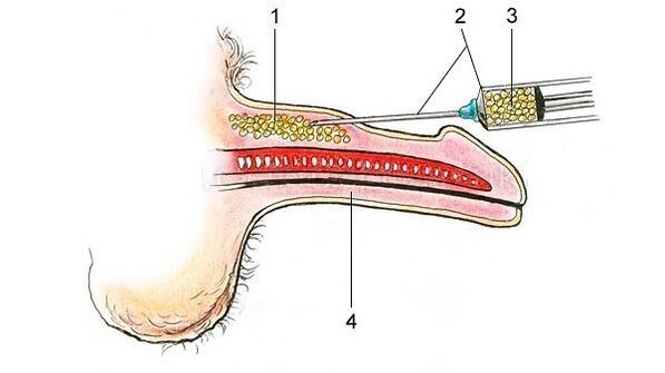Hyaluronic acid injection for penis thickening